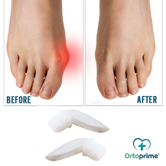 Kit Séparateur pour Hallux Valgus | 2 Unités